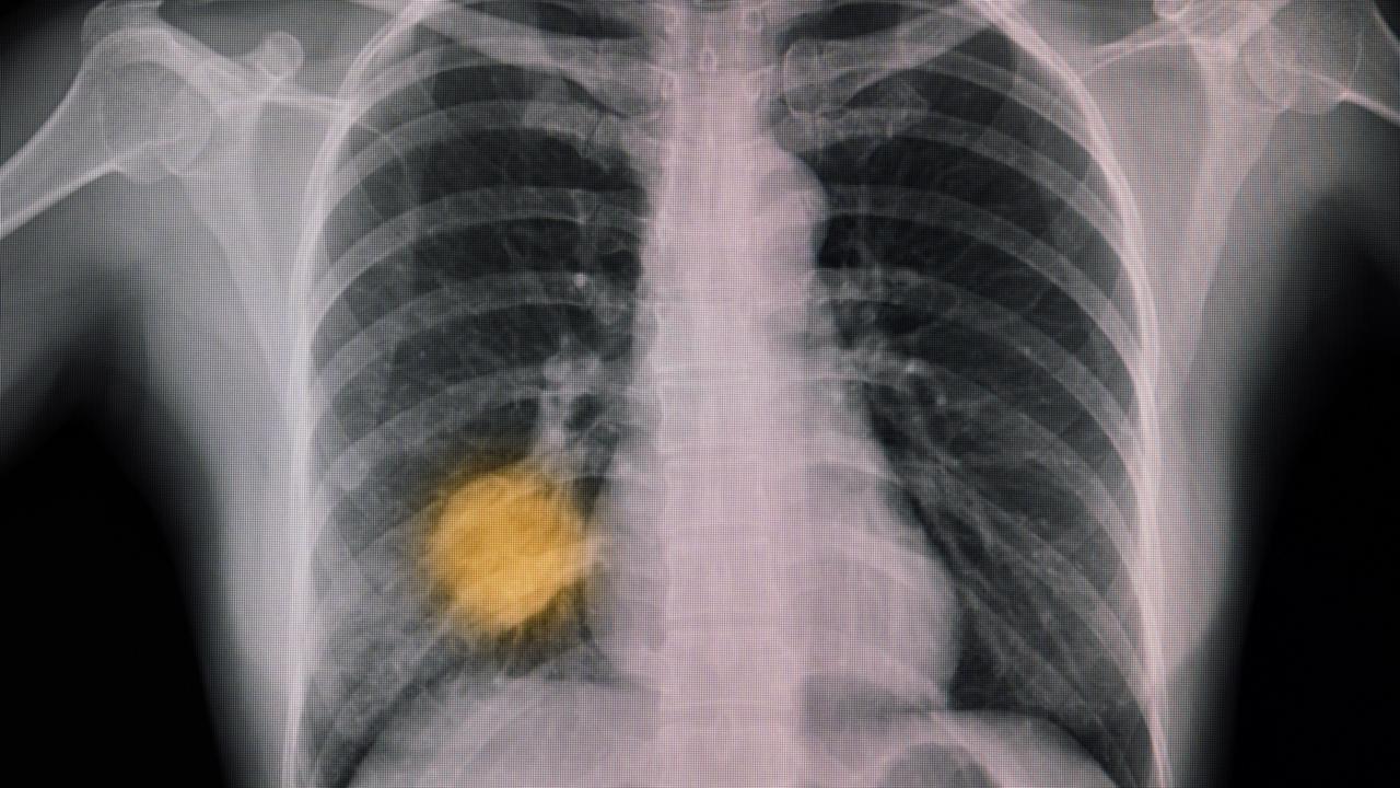 Study reveals groundbreaking new AI can detect lung cancer earlier