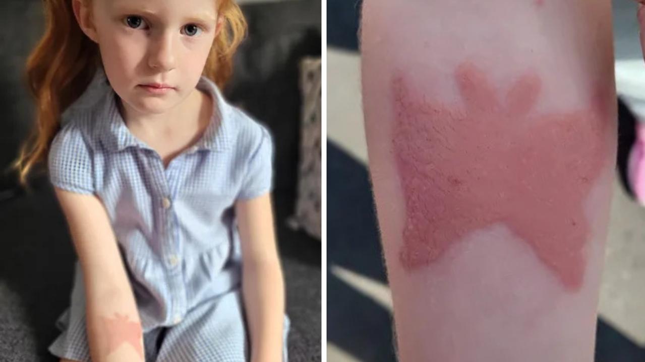 UK girl scarred by temporary black henna butterfly tattoo while on holiday in Turkey