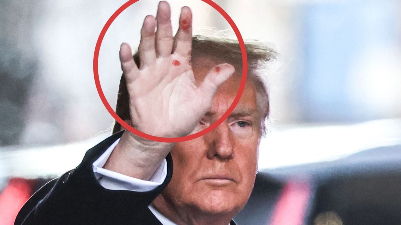 Red splotches on Donald Trump’s hands spark debate