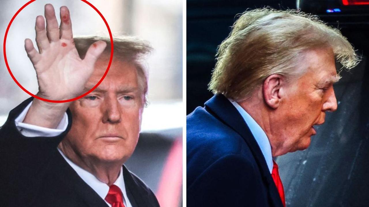 Red spots on Donald Trump’s hand cause revealed